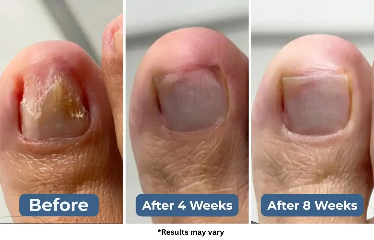 Okita Nail Fungus Light Before and After Okita Nail Fungus Light Before and After